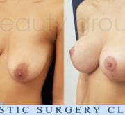 Breast enlargement with mastopexy - Beauty Group