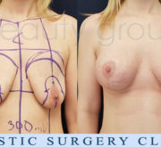 Breast enlargement with mastopexy - Beauty Group