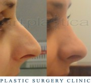 Nose correction (Rhinoplasty)