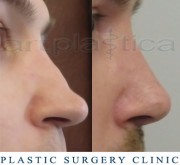 Nose correction (Rhinoplasty) - before and after surgery