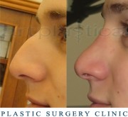 Nose correction (Rhinoplasty)