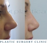 Nose correction (Rhinoplasty)