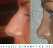 Nose correction (Rhinoplasty)