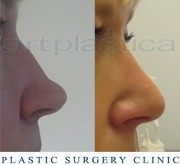 Nose correction (Rhinoplasty)