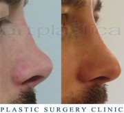 Nose correction (Rhinoplasty)