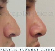 Nose correction (Rhinoplasty)