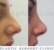 Nose correction (Rhinoplasty) - before and after surgery