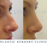 Nose correction (Rhinoplasty)