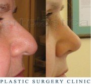 Nose correction (Rhinoplasty) - before and after surgery