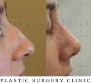 Nose correction (Rhinoplasty)