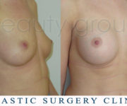 Breast enlargement - photo before and after surgery - Beauty Group