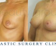 Breast enlargement - photo before and after surgery - Beauty Group