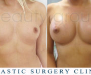 Breast enlargement - photo before and after surgery - Beauty Group