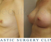 Breast enlargement - photo before and after surgery - Beauty Group