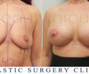 Breast enlargement - photo before and after surgery - Beauty Group