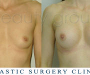 Breast enlargement - photo before and after surgery - Beauty Group