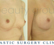 Breast enlargement - photo before and after surgery - Beauty Group