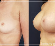 Breast enlargement 