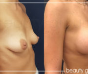 Breast enlargement