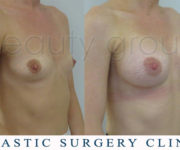 Breast enlargement - photo before and after surgery - Beauty Group