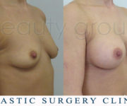 Breast enlargement - photo before and after surgery - Beauty Group