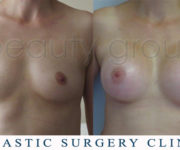 Breast enlargement - photo before and after surgery - Beauty Group