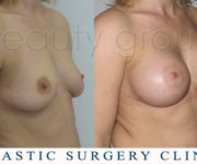 Breast enlargement - photo before and after surgery - Beauty Group