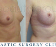 Breast enlargement - photo before and after surgery - Beauty Group