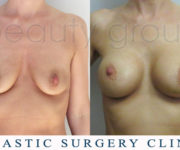 Breast enlargement - photo before and after surgery - Beauty Group