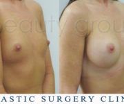 Breast enlargement - photo before and after surgery - Beauty Group