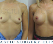 Breast enlargement - photo before and after surgery - Beauty Group