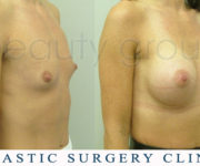 Breast enlargement - photo before and after surgery - Beauty Group