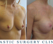 Breast enlargement - photo before and after surgery - Beauty Group