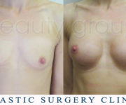 Breast enlargement - photo before and after surgery - Beauty Group