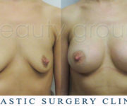 Breast enlargement - photo before and after surgery - Beauty Group