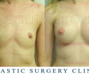 Breast enlargement - photo before and after surgery - Beauty Group