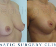 Breast enlargement - photo before and after surgery - Beauty Group