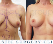 Breast enlargement - photo before and after surgery - Beauty Group