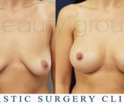Breast enlargement - photo before and after surgery - Beauty Group
