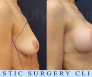 Breast enlargement - photo before and after surgery - Beauty Group