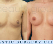 Breast enlargement - photo before and after surgery - Beauty Group