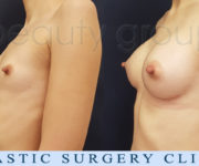 Breast enlargement - photo before and after surgery - Beauty Group