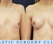 Breast enlargement - photo before and after surgery - Beauty Group