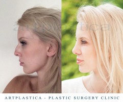 Kinga - nose in profile before and after