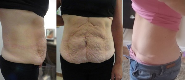 TUMMY TUCK before and after. Plastic Surgery in Poland