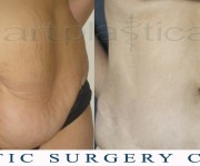 Abdominoplasty (Tummy Tuck) - before and after 5 years