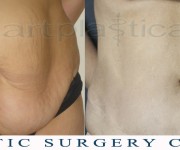 Anna - tummy tuck