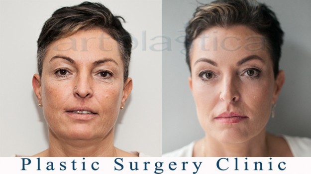 Aesthetic Medicine - before and after