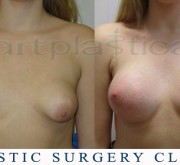 Breast enlargement (asymmetry) - photo before and after surgery