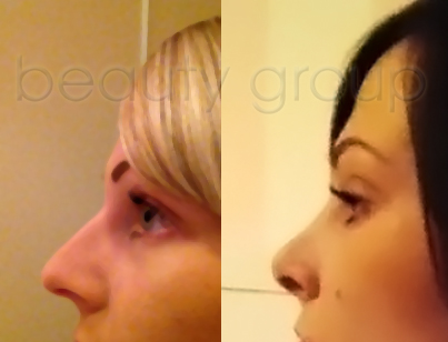 Alice - nose correction - before and after